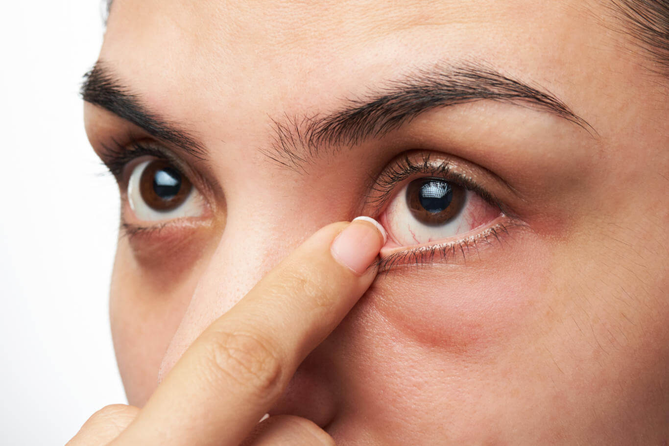 Diabetic Eyes